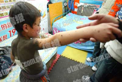 ��ͯ���ֲ������L(zh��ng)�M�ڸ��� �t(y��)���_�\��ë��(�D)